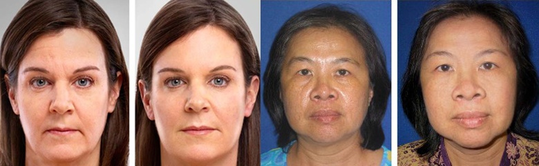 anti aging results stem cells antiaging results