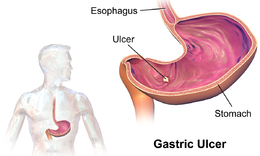 Gastric Ulcer - Stem cell treatment
