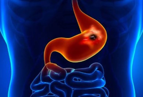 Peptic ulcer disease