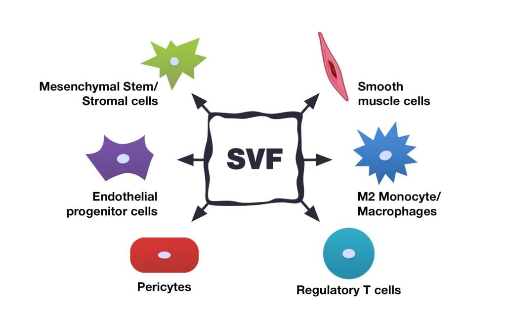 Picture 1. Cellular subsets within the SVF (modified from the original source). The SVF includes several stem cells types: multipotent mesenchymal stromal cells (multipotent MSCs), pericytes, and supra-adventitial cells. It also contains both progenitors (which can further differentiate into cells of blood vessel walls, fat tissue cells, and some others) and mature cells – fibroblasts, smooth muscle cells, endothelial cells, and fat tissue cells. The SVF also contains growth factors and other biologically active components.