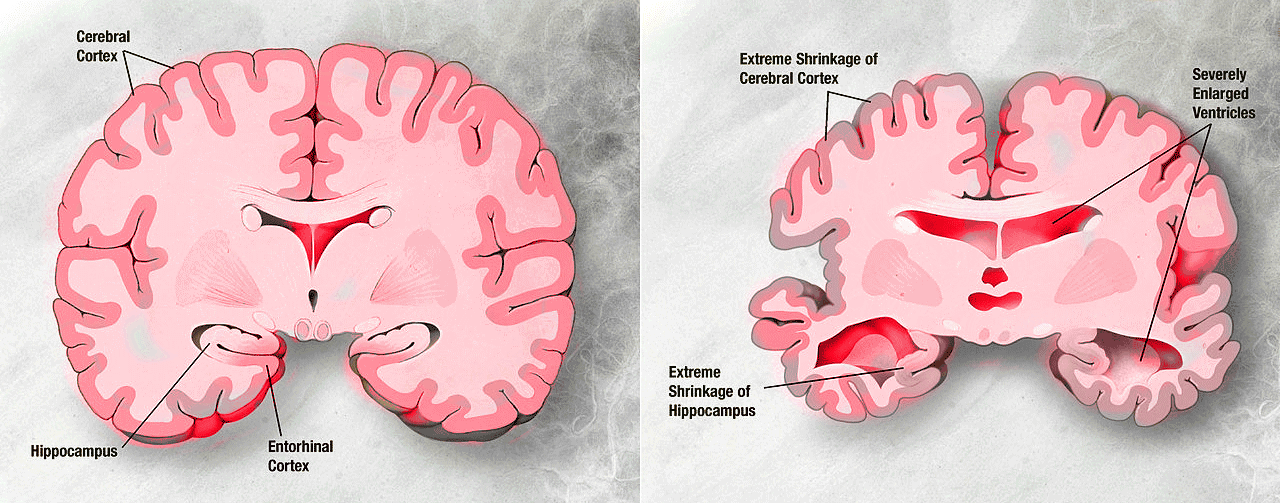 Brain cells damage alzheimer disease
