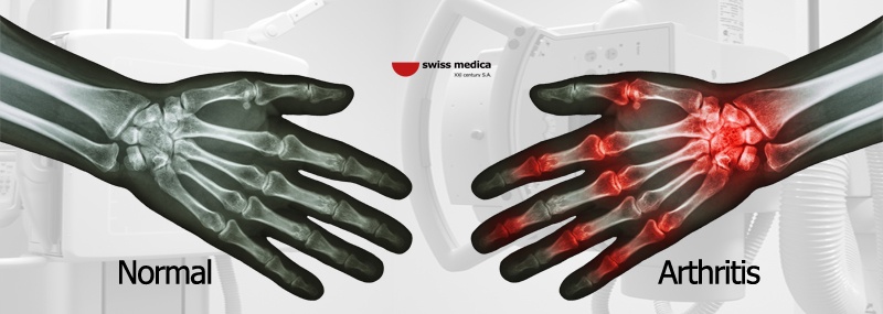 Symptoms of arthritis