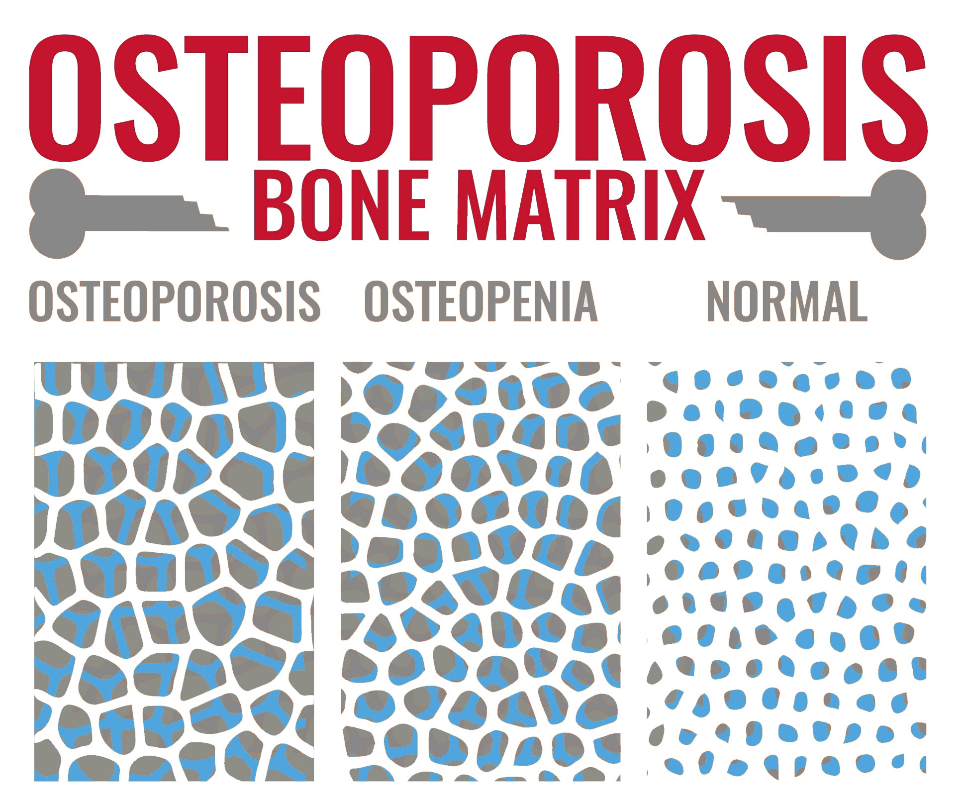 Stem cells osteoporosis therapy