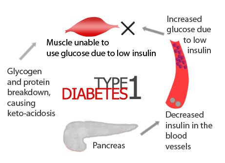 type 1 diabetes causes