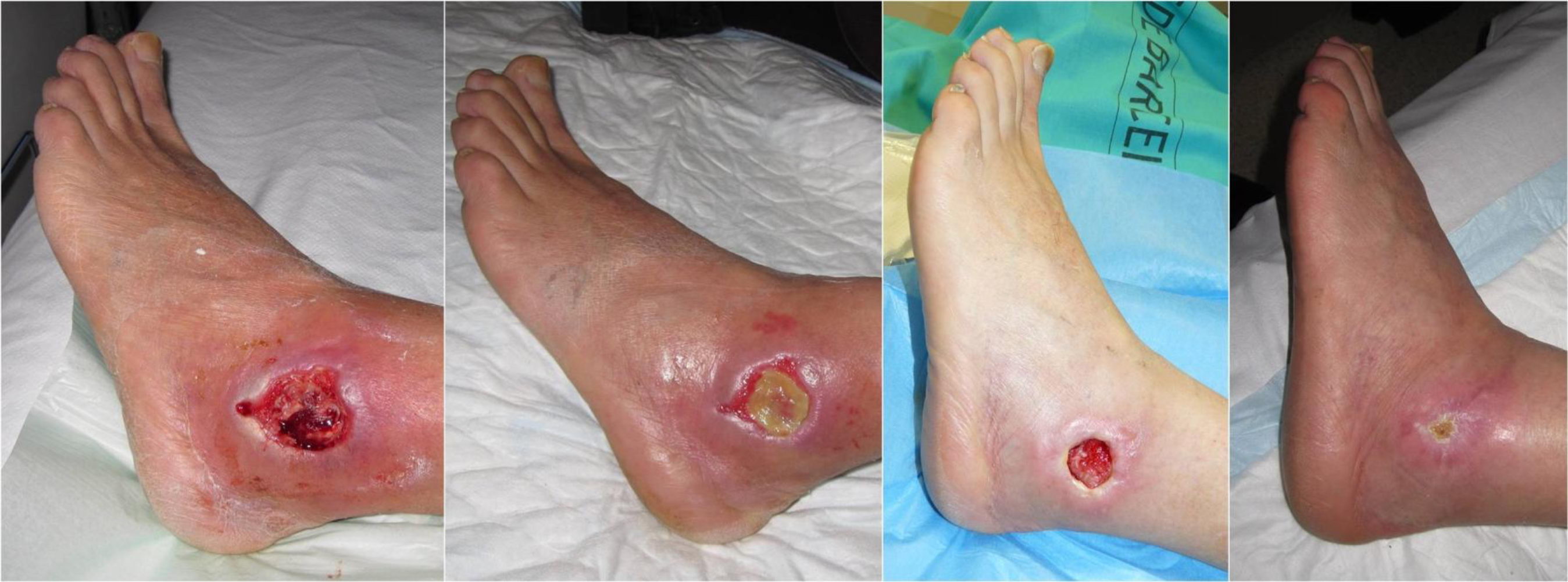 diabetic foot swiss medica stem cells clinic treatment