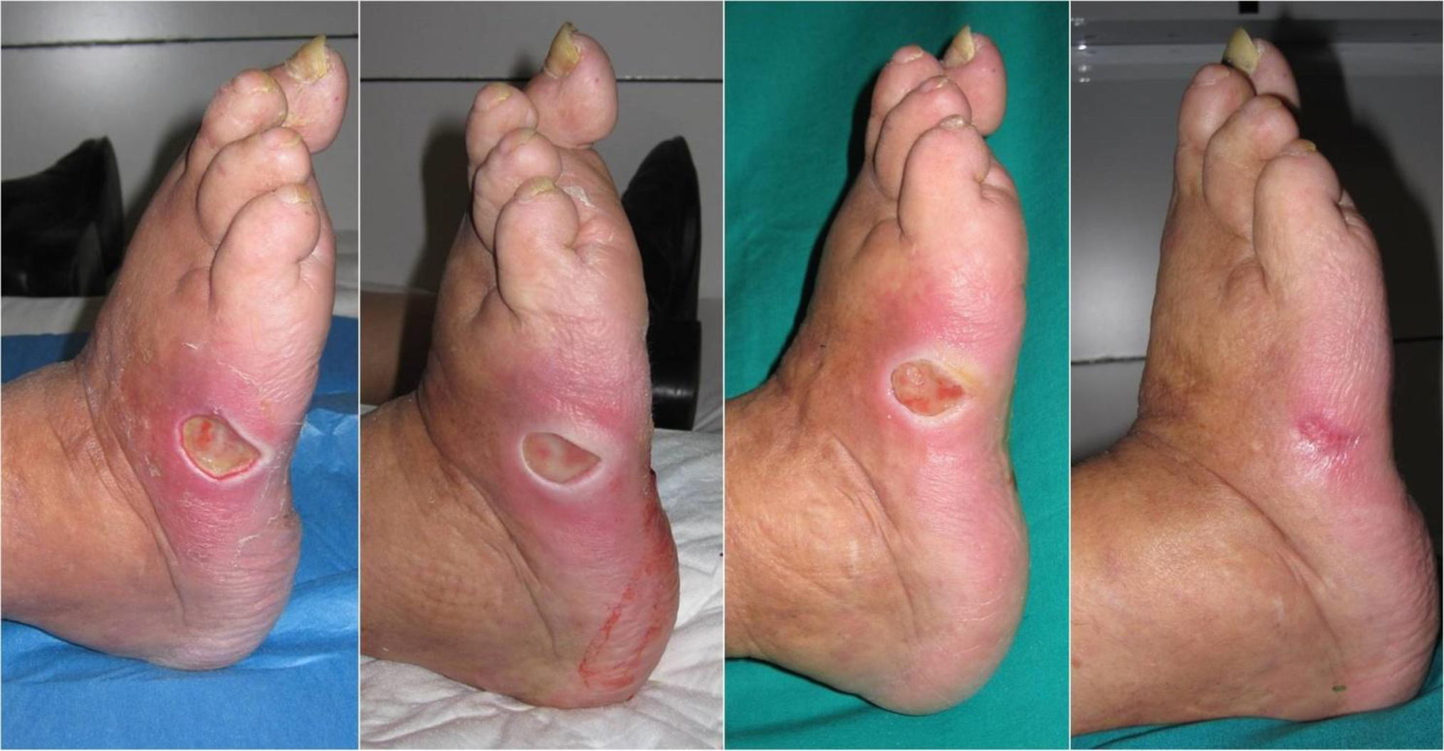 diabetic foot swiss medica stem cells clinic treatment