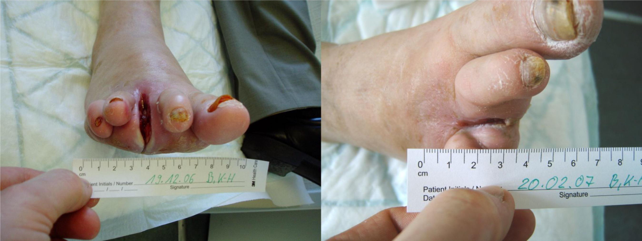 diabetic foot swiss medica stem cells clinic treatment