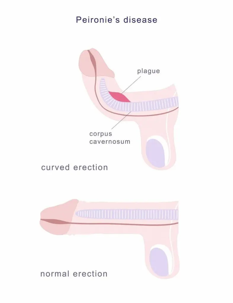 What is Peyronie's disease
