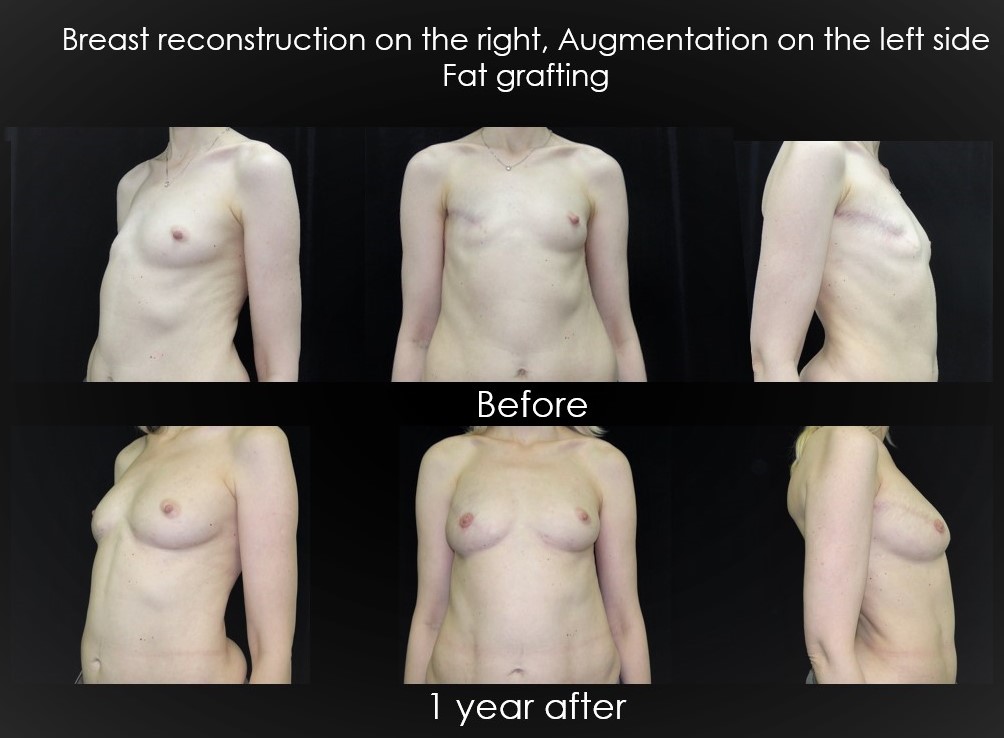 Breast reconstruction with fat grafting. Swiss Medica