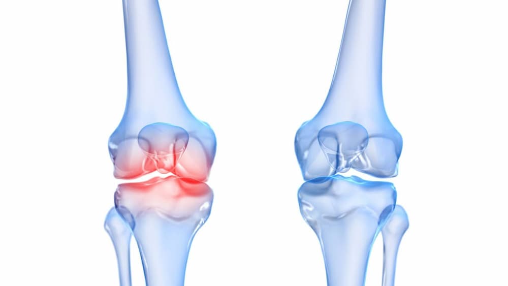 Pain in the knee due to arthritis.