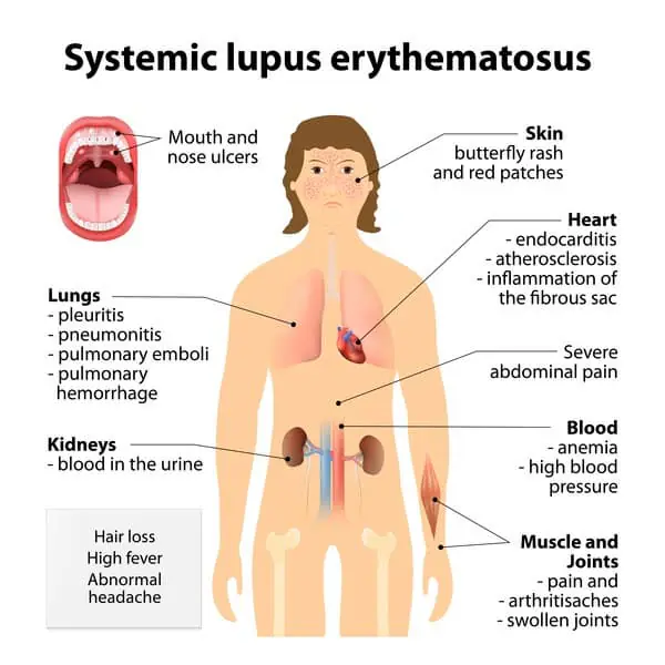 Stem Cell Treatment for Systemic Lupus Erythematosus