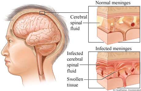 Meningitis Treatment with Stem Cells