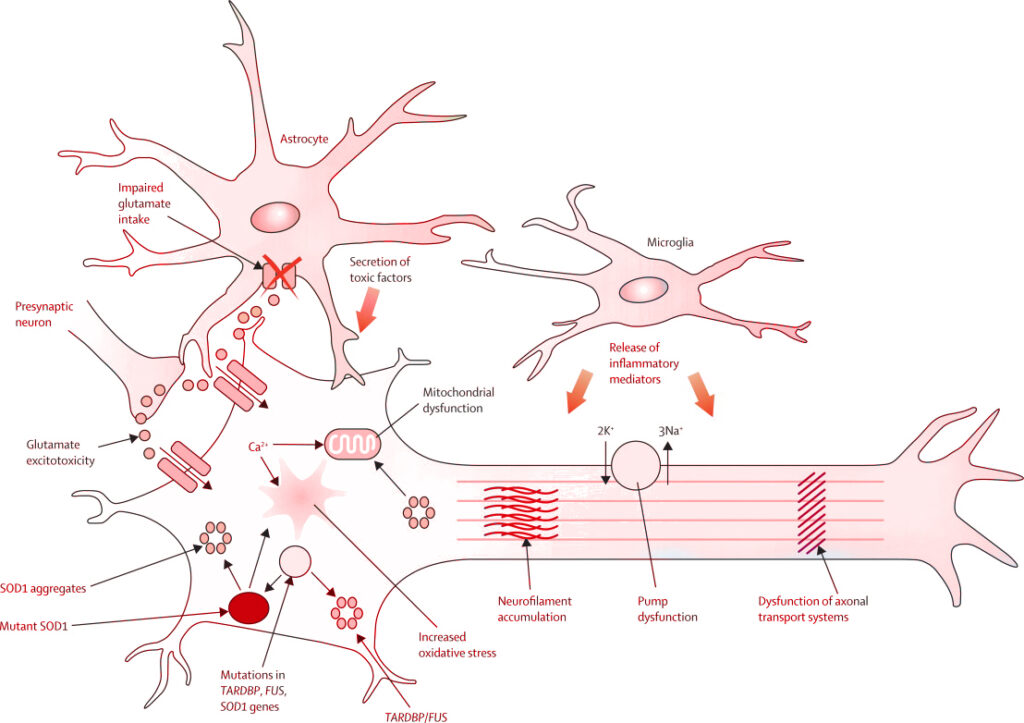 Trattamento della SLA con le cellule staminali