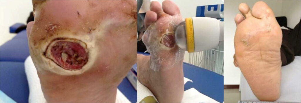 Diabetic Foot Treatment with Stem Cells