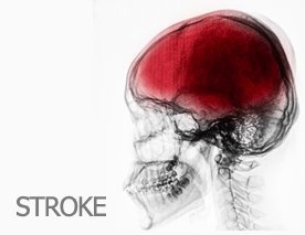 Stem Cell Treatment for Post-Stroke Condition