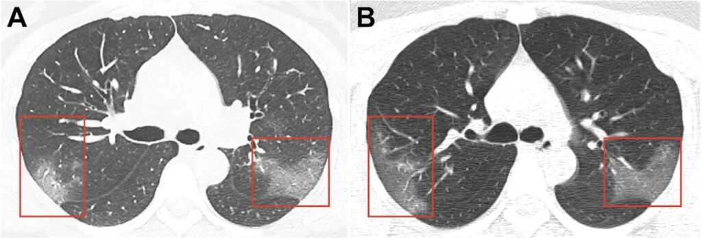 Potential of Mesenchymal stem cells (MSC) in Rehabilitation after Coronavirus COVID-19 and Treatment of its Complications such as Pulmonary Fibrosis