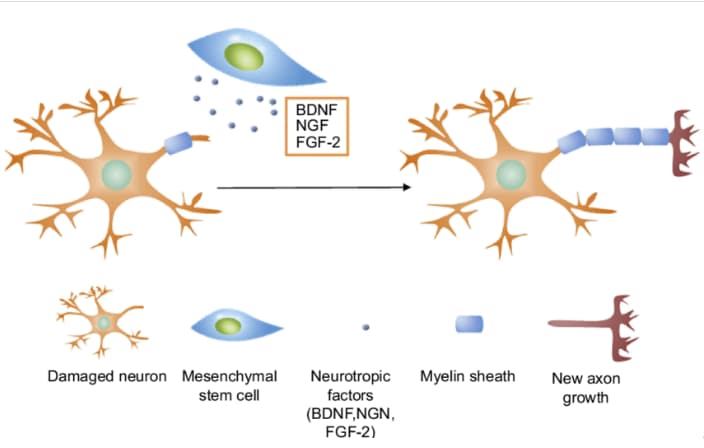 Stem Cell Treatment for Ataxia