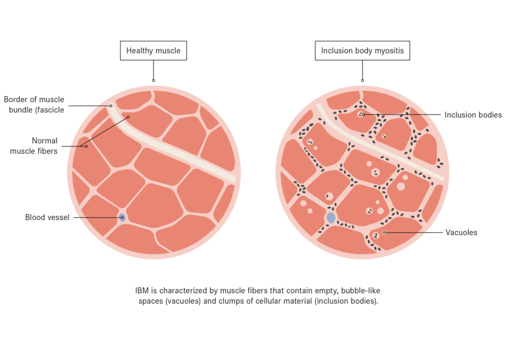 Inclusion Body Myositis Treatment with Stem Cells