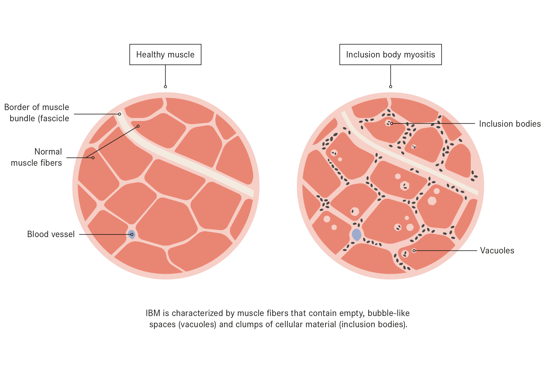 Inclusion Body Myositis Treatment With Stem Cells Swiss Medica Inclusion Body Myositis Treatment With Stem Cells Swiss Medica