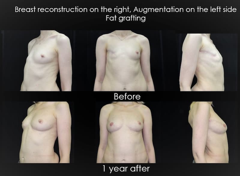 Breast Reconstruction with Fat Grafting