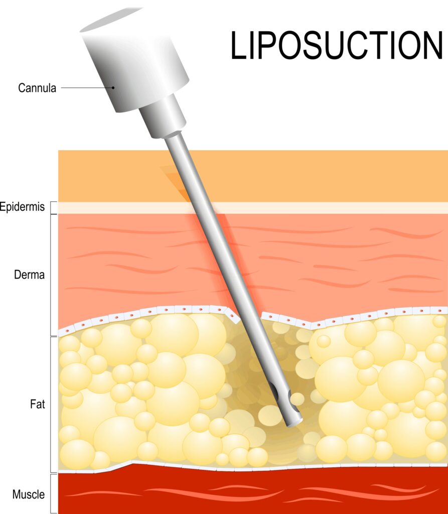 Treatment of Rectovaginal Fistula, Rectal Ulcers or Anal Fissure with Stem Cell Injections