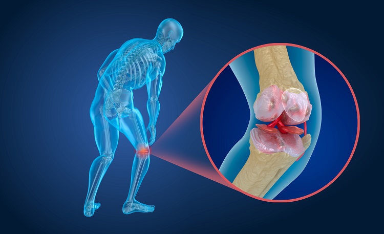 Léčba artritidy kmenovými buňkami
