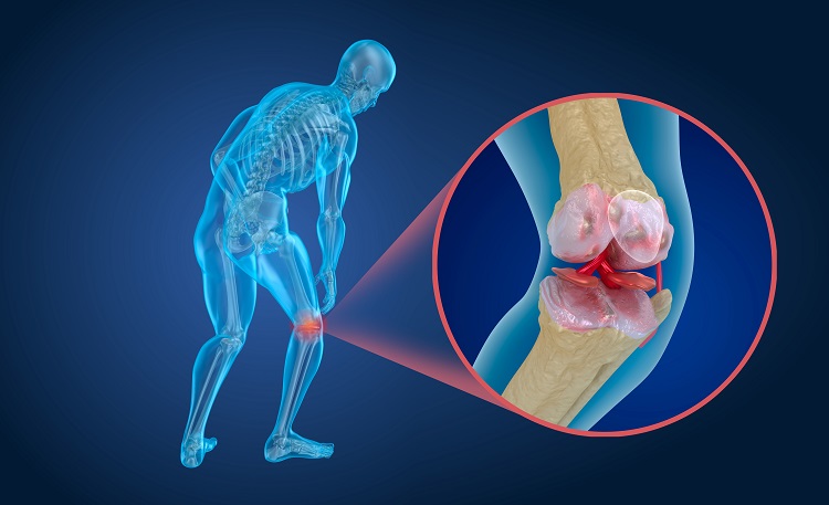 Traitement de l'arthrite avec des cellules souches