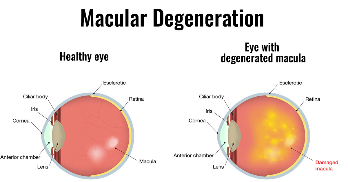 Macular Degeneration Treatment with Stem Cells Swiss Medica