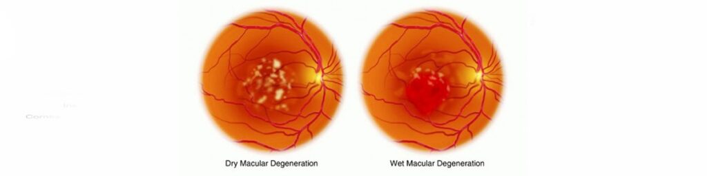 Macular Degeneration Treatment with Stem Cells