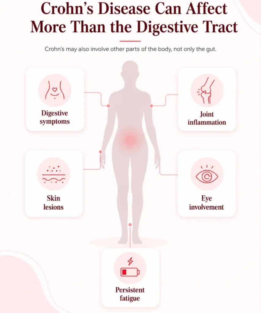 Crohn symptoms