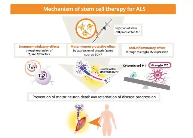 ALS Treatment with Stem Cells