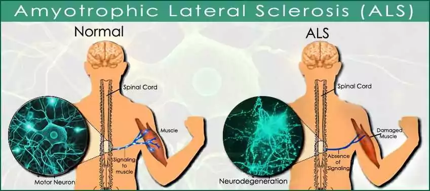 ALS (Lou Gehrig’s Disease): Early Signs and Symptoms