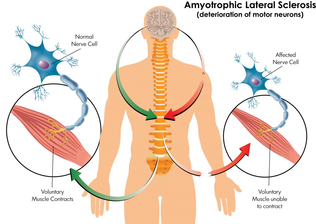 Traitement par cellules souches pour la maladie du motoneurone (MND)