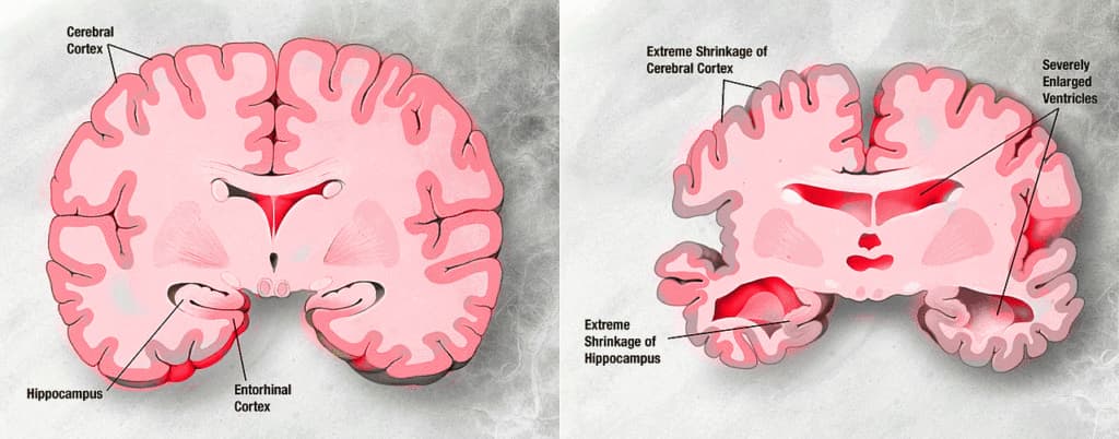 Traitement de la maladie d'Alzheimer avec la thérapie par cellules souches et alzheimer