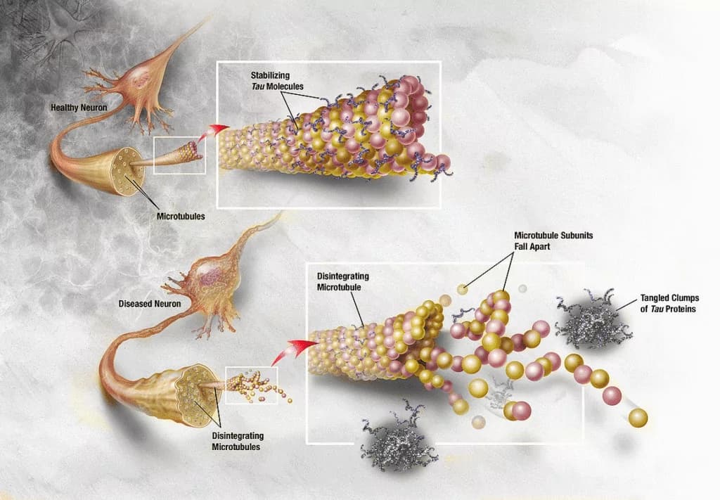 Behandlung der Alzheimer-Krankheit mit Stammzellentherapie