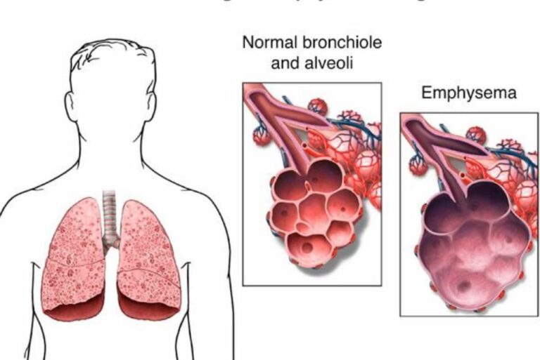 Emphysema Diagnosis And Treatment Swiss Medica