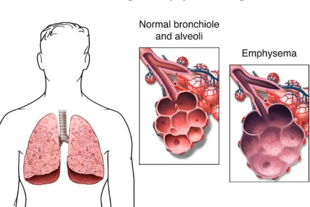 Emphysema — Diagnosis and Treatment