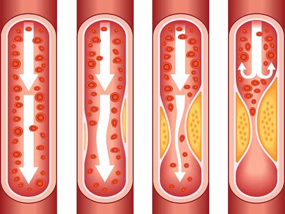 Stem Cell Therapy for Hypertension