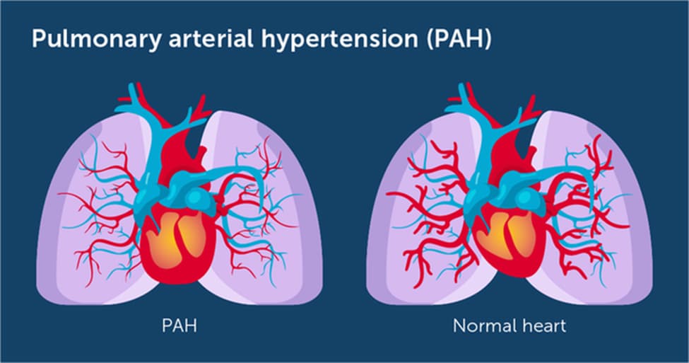 PAH vs. Normal Heart
