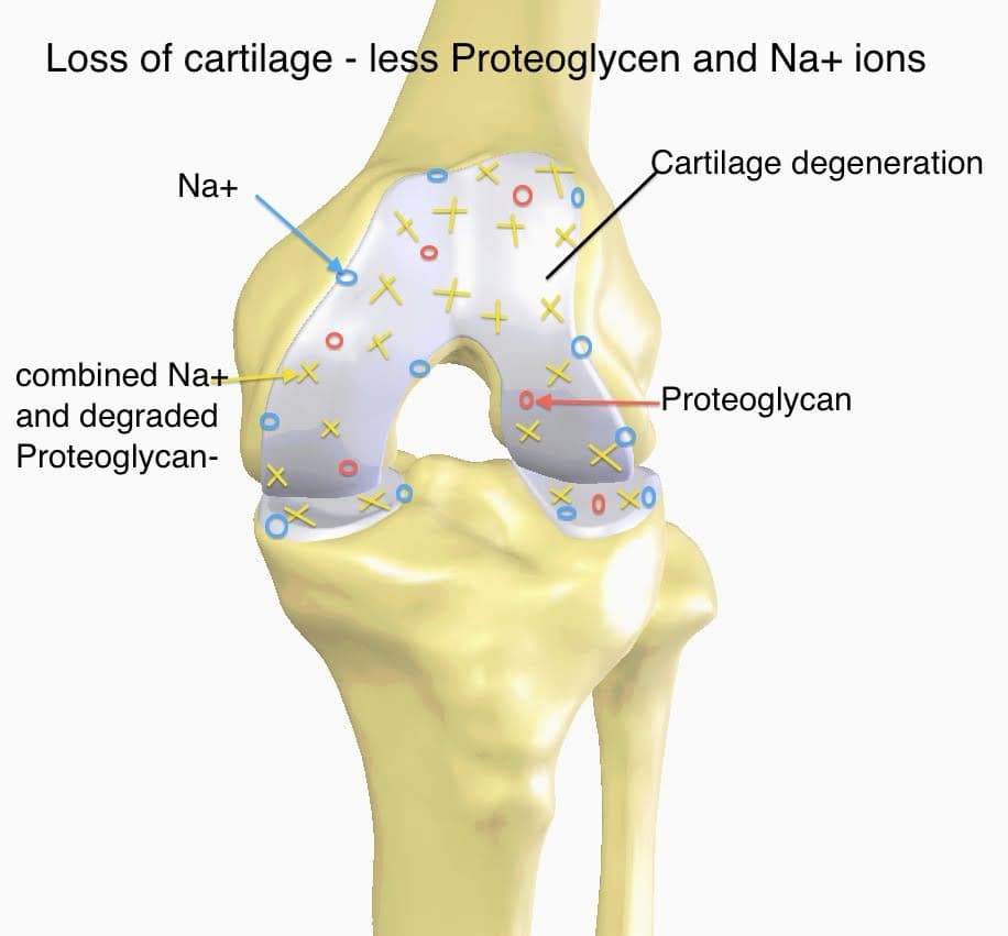 Mesenchymal Stem Cells in Knee Osteoarthritis: A Promising Approach