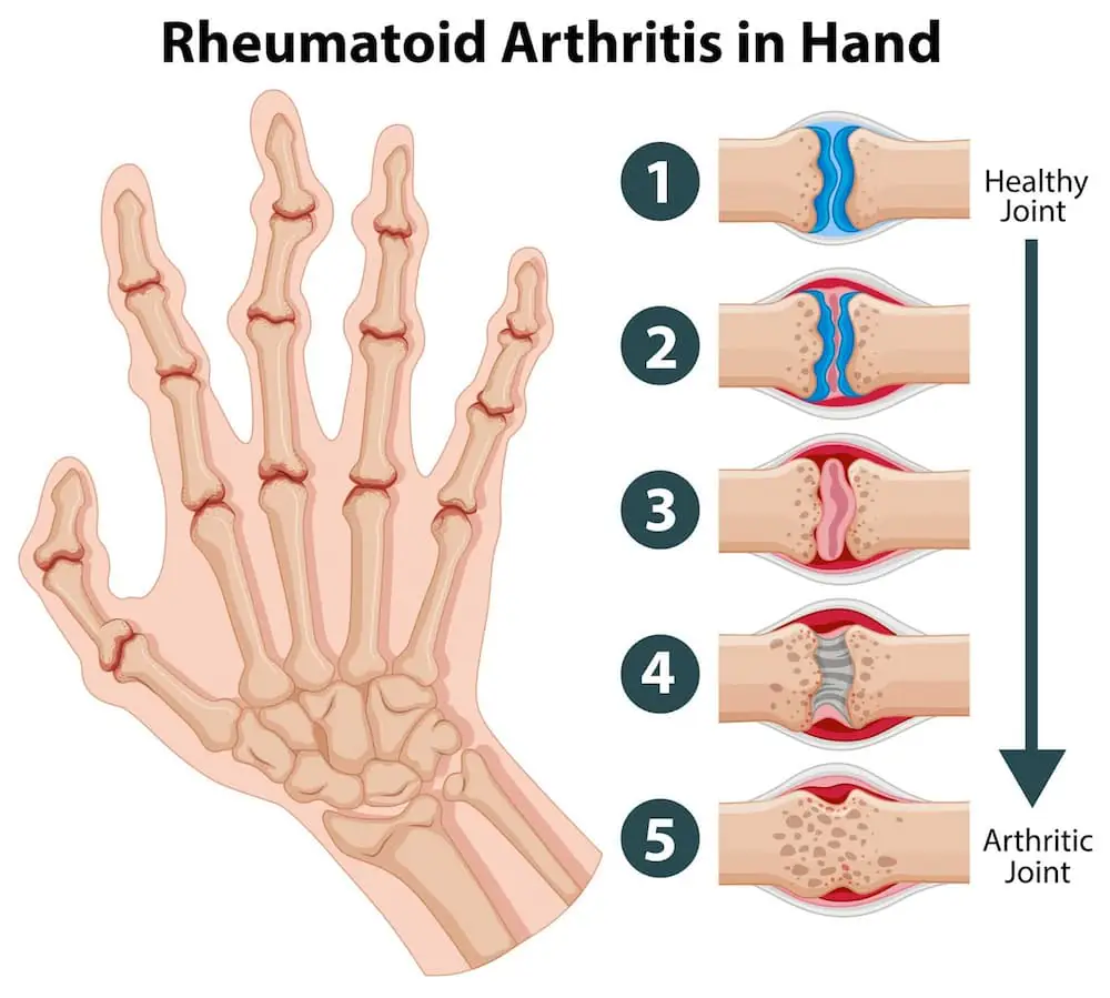 Stem Cell Therapy for Rheumatoid Arthritis