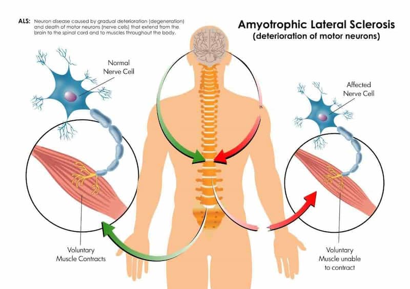 Exploring Alternative Therapies for ALS: From Acupuncture to Yoga