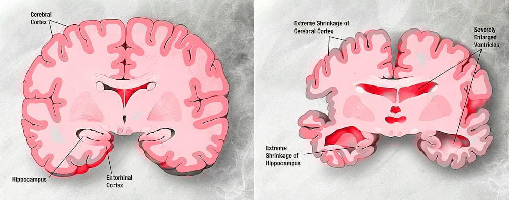 Trattamento della Demenza con le Cellule Staminali