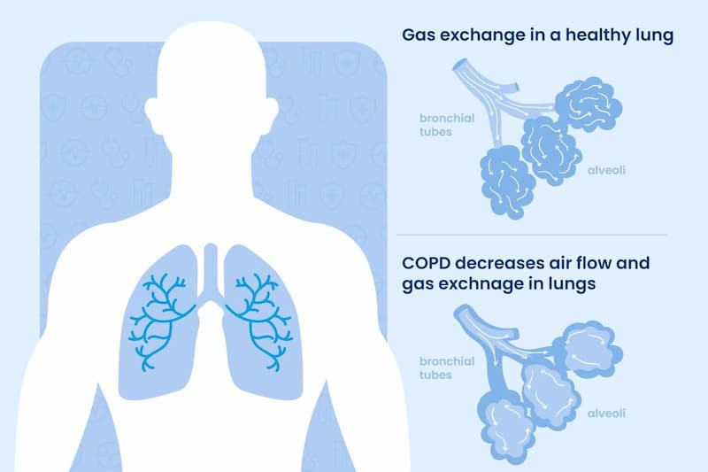 What Is COPD? Understanding Chronic Obstructive Pulmonary Disease