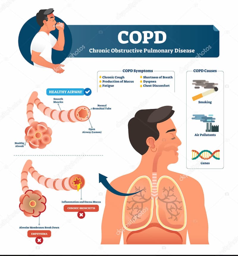 Early Signs of COPD: Recognizing the Symptoms and Seeking Diagnosis