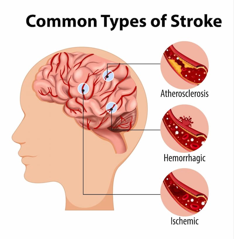 Three main types of strokes have different genetics and could lead to different treatments.

