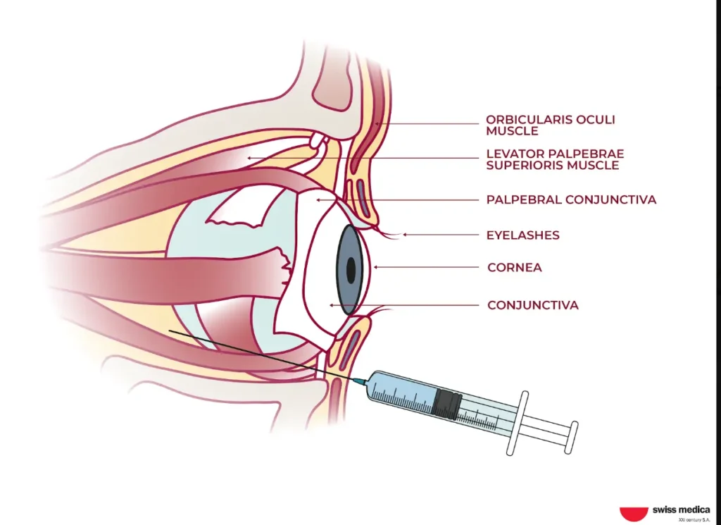 Rerobulbar injections