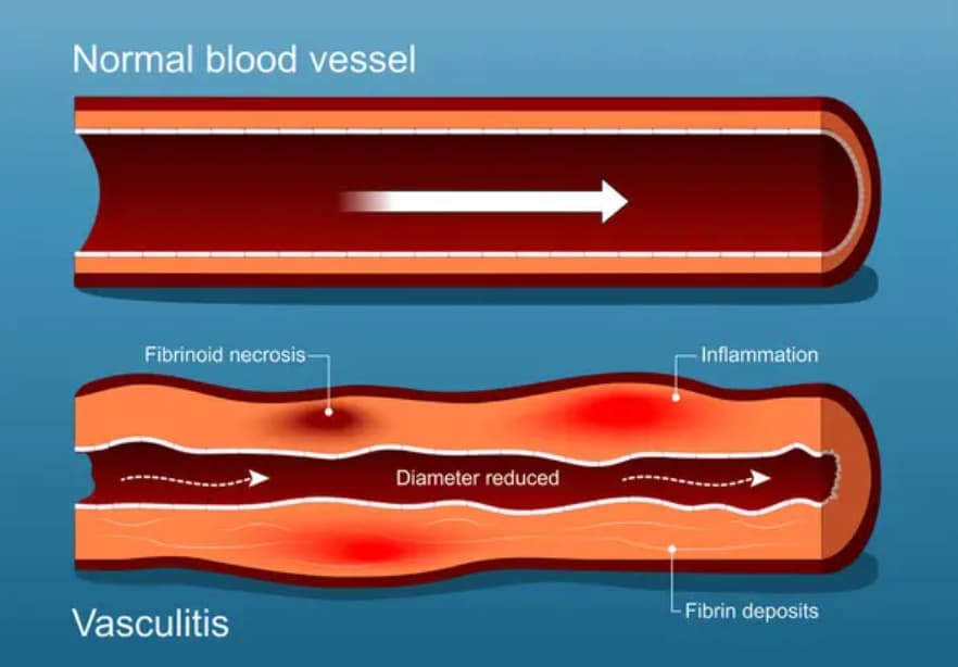 Stem Cell Therapy for Cerebral Vasculitis