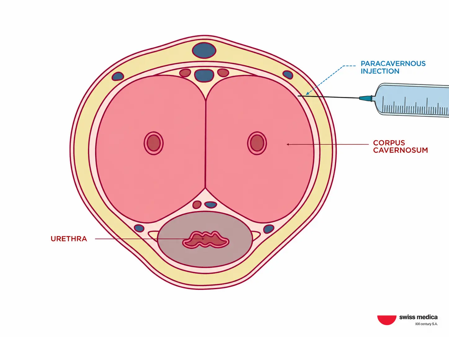 Paracavernous stem cell injections