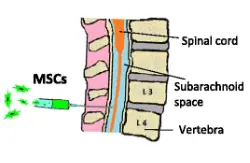 Traitement par Cellules Souches de L’ataxie